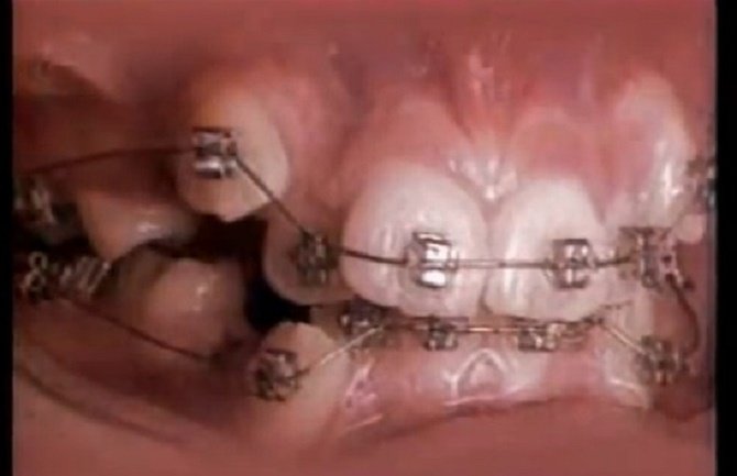 Evo šta fiksna proteza radi sa vašim zubima (VIDEO)