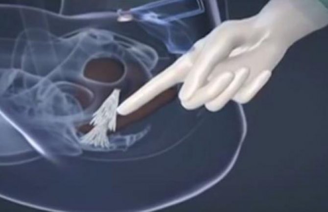 Evo kako izgleda operacija promjene pola (VIDEO)