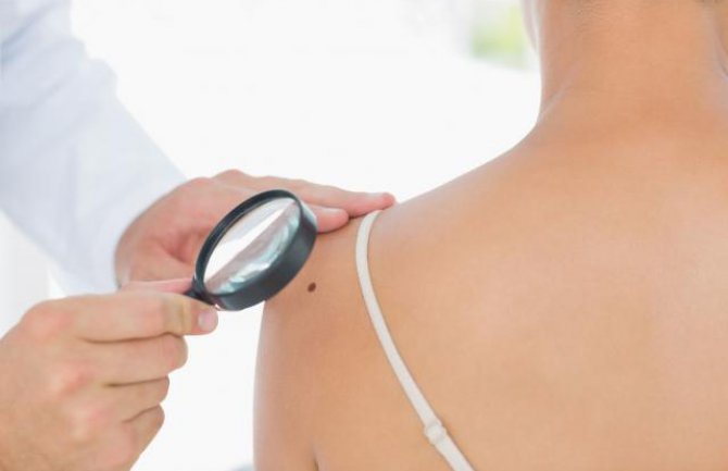 Provjerite da li vam prijeti rizik od raka kože