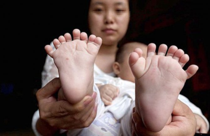 Beba rođena sa 15 prstiju na rukama i 16 na nogama