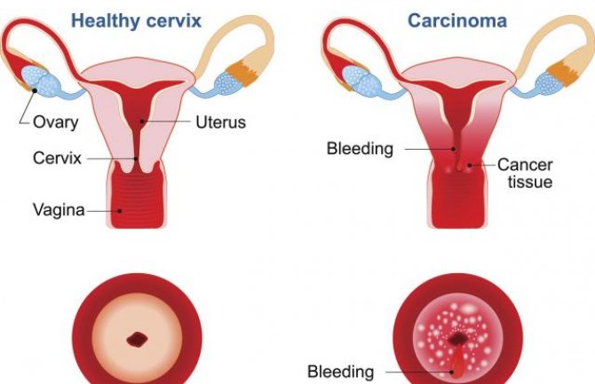 Spriječite infekciju koja je glavni uzrok dobijanja raka kod žena