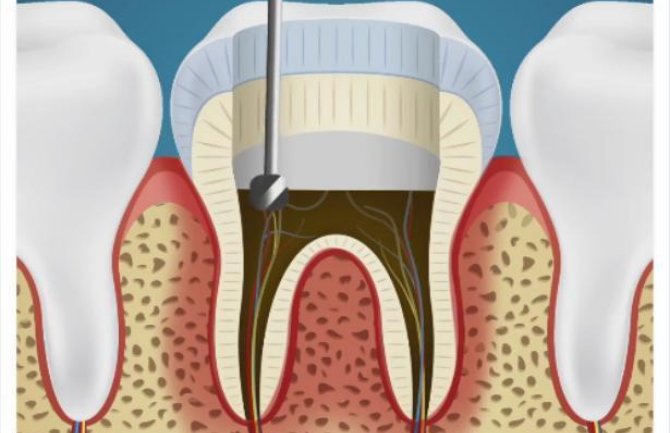  Evo šta zubar radi dok vam popravlja zube (VIDEO)