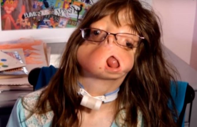 Djevojčica koja se rodila bez lica: Pogledajte kako izgleda nakon 12 godina i 45 operacija (VIDEO)