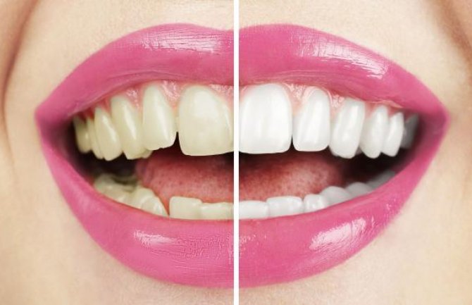 Evo kako da izbijelite zube na prirodan način