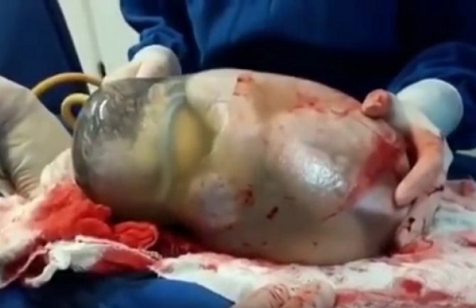 Ovo se rijetko viđa:  Beba rođena u posteljici s plodovom vodom (VIDEO)