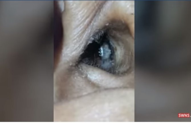 Nakon jake glavobolje ljekari joj pronašli živog pauka u uhu(VIDEO)