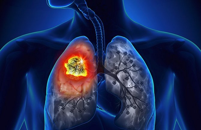Evo šta je najčešći uzrok raka pluća