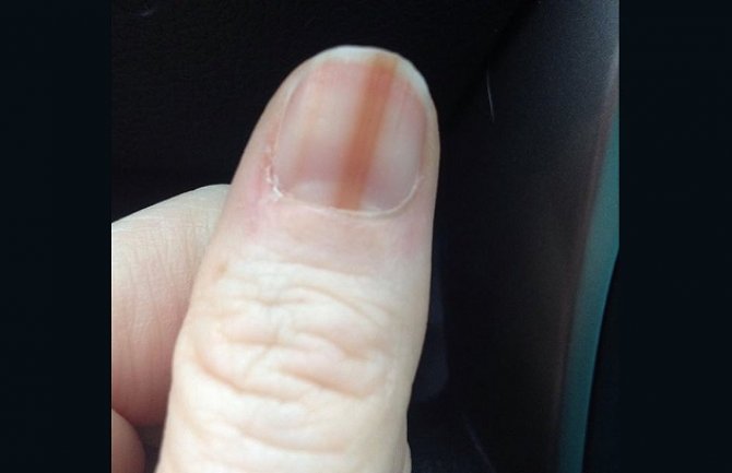 Ako uočite ovakvu pojavu na noktima, odmah se obratite ljekaru (FOTO)