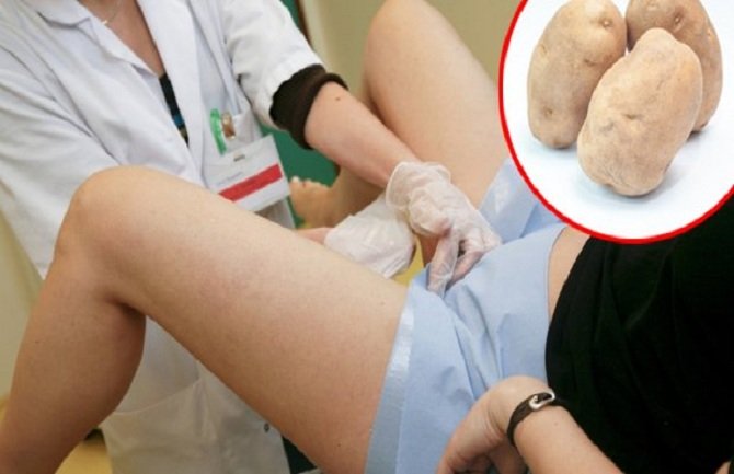 Ljekari ženi izvadili krompir iz vagine, nećete pogoditi odakle on tamo