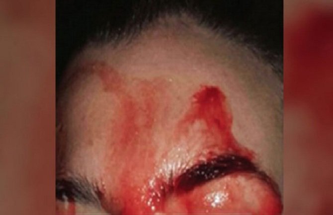 Pogledajte ovaj medicinski fenomen: Umjesto znoja, lije joj krv (FOTO)