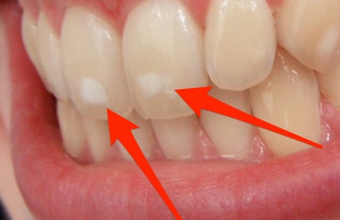 Zašto nastaju bijele mrlje na zubima?