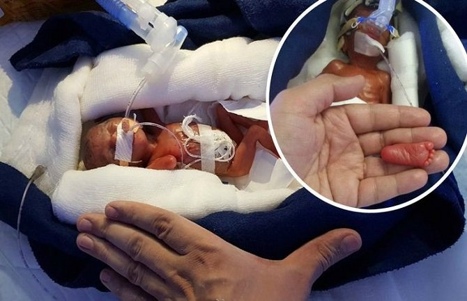 Beba rođena sa samo 400 grama izborila se za život