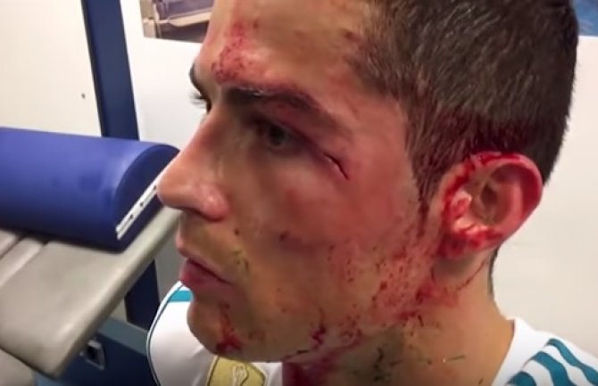 Lice u krvi: Ronaldo povrijeđen tokom meča sa Deportivom (VIDEO)
