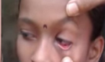 Pogledajte djevojčicu kojoj iz očiju izlaze mrtvi mravi (VIDEO)
