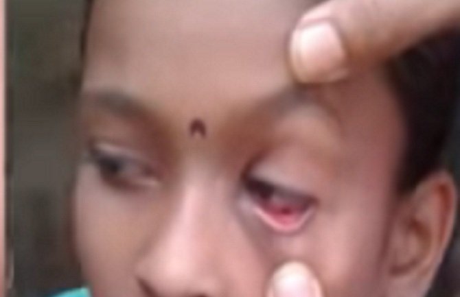Pogledajte djevojčicu kojoj iz očiju izlaze mrtvi mravi (VIDEO)