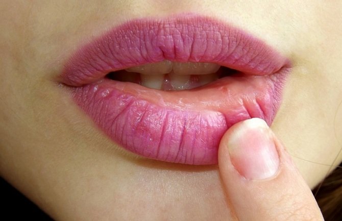 Fleke na usnama su opasan znak bolesti