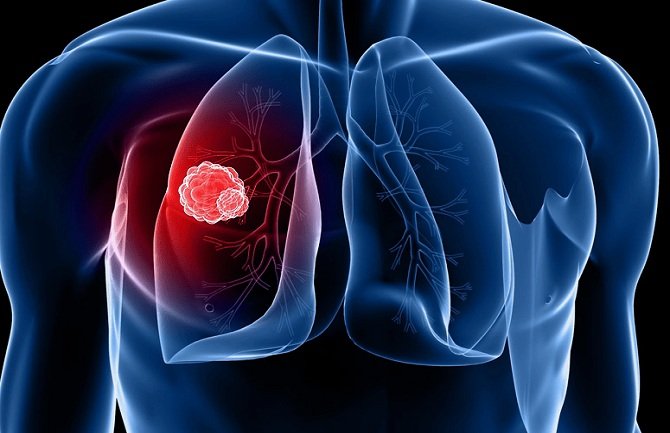 U Crnoj Gori karcinom pluća odnosi najviše života