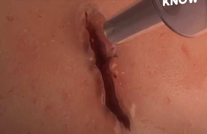 Naučnici stvorili hirurški lijepak koji zatvara rane za jedan minut (VIDEO)