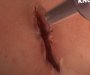 Naučnici stvorili hirurški lijepak koji zatvara rane za jedan minut (VIDEO)