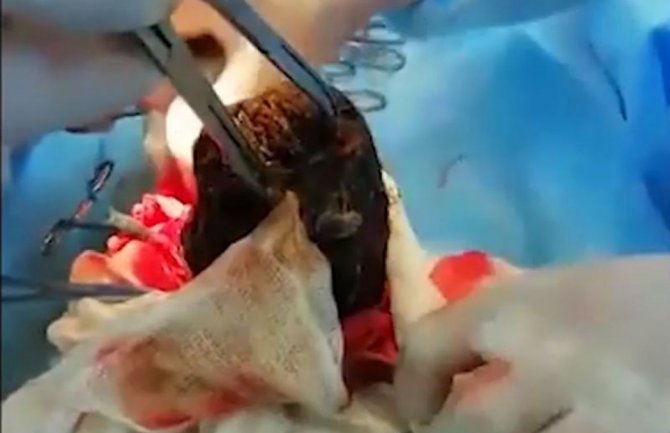 Djevojčica primljena u bolnicu nakon što je potpuno izgubila apetit, hirurzi joj izvadili 3 i po kg dlaka (VIDEO)