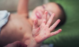 Od virusa HFMD zaraženo više od 50.000 djece