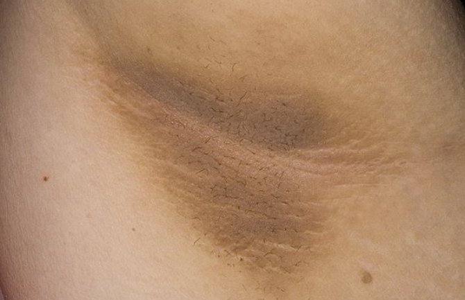 OVE promjene na koži mogu biti znak dijabetesa ili raka (FOTO)
