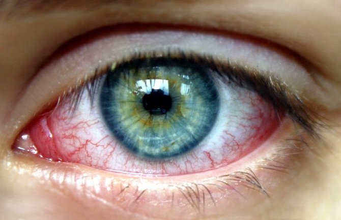 Pucanje kapilara u oku: Kada ovo stanje postaje opasno?