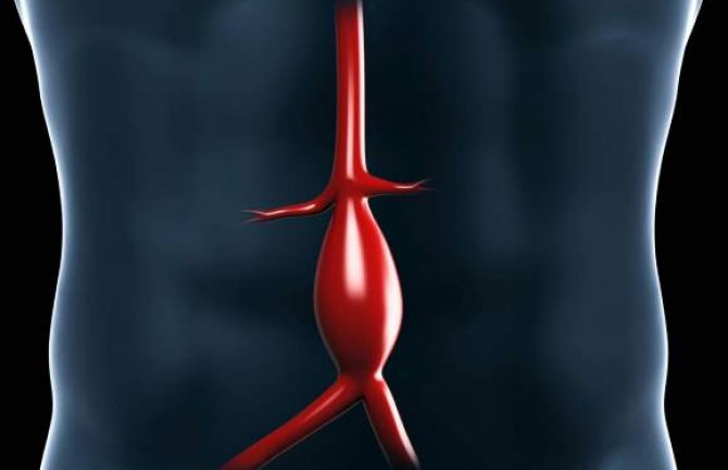 Šta je aneurizma trbušne aorte, kako se otkriva i liječi i zašto je opasna? 