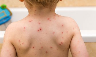 Epidemija varičela u Herceg Novom, preko 300 oboljelih