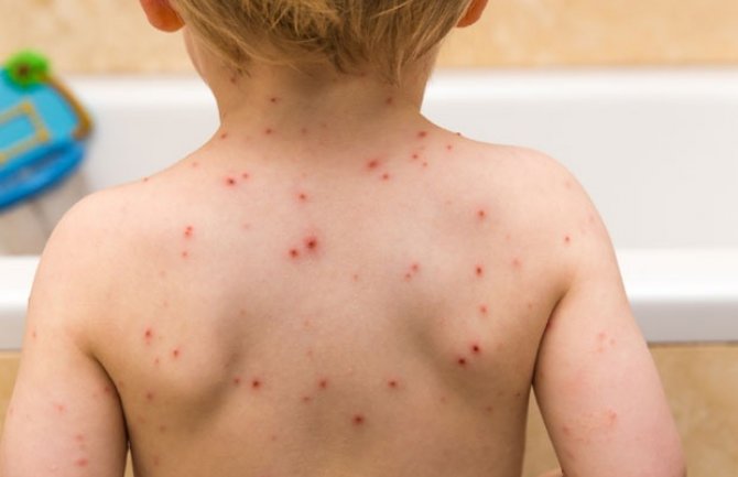 SZO: Vakcine protiv malih boginja se ne smiju preskakati