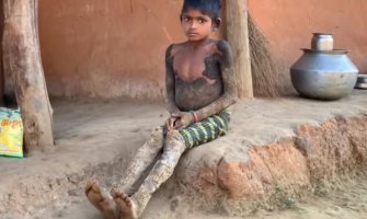 Indija: Djevojčica boluje od rijetke bolesti koja je pretvara u kamen (VIDEO)