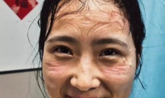 Kineski doktori pokazali lica posle nošenja maski: Ovako izgledaju pravi heroji