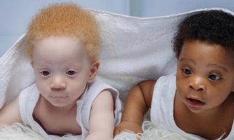 Blizanci rođeni sa različitom bojom kože