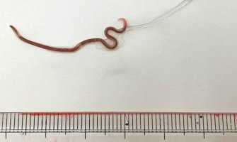 Gadno iznenađenje: Jela sirovo meso i u grlu joj pronašli crva od četiri centimetra