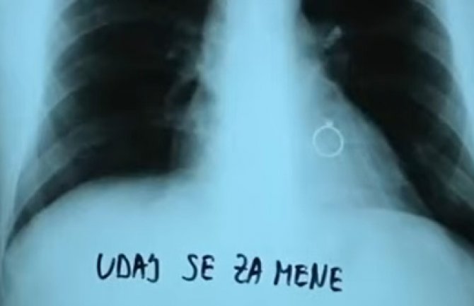 Najljepši snimak pluća koji doktorka može da pogleda: Prsten na srcu nakon preležane bolesti (Video)
