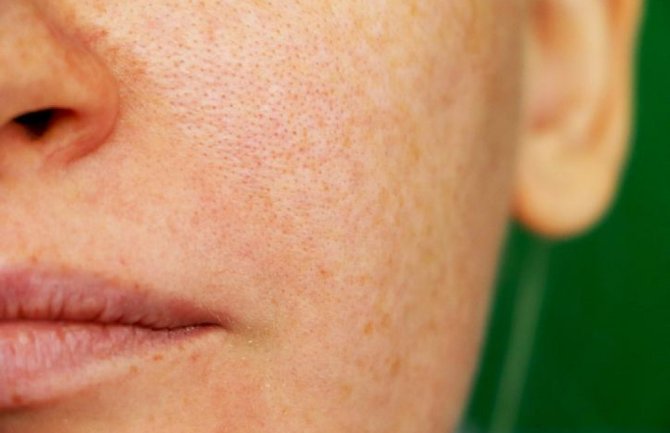 Kako smanjiti proširene pore na licu