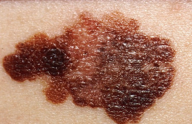 Provjerite da li imate rak kože (FOTO)