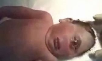 Rođena beba sa jednim okom na sredini čela