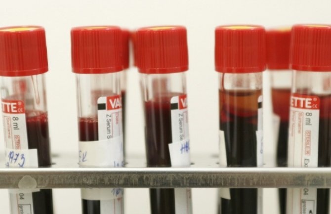 Novom analizom krvi otkrićete hroničnu bolest tri godine unaprijed