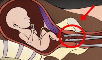 Uznemirujući video: Ginekolog otkriva šta se dešava sa bebom tokom abortusa! 