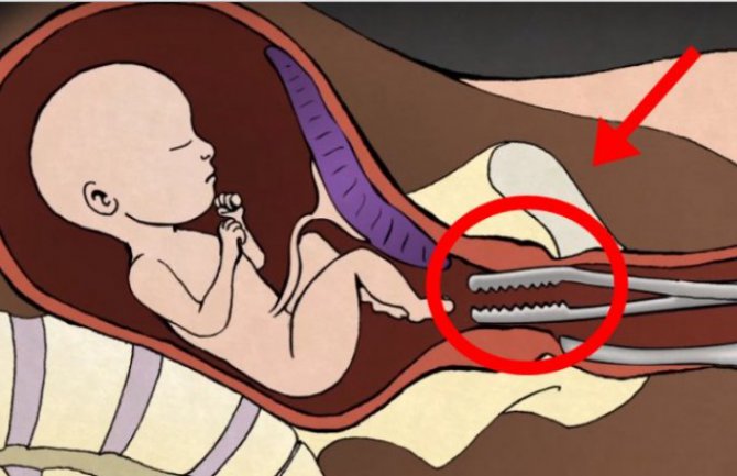 Uznemirujući video: Ginekolog otkriva šta se dešava sa bebom tokom abortusa! 