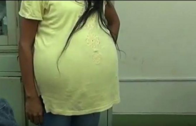 Iz stomaka djevojke otklonili tumor težak 15 kg (VIDEO)