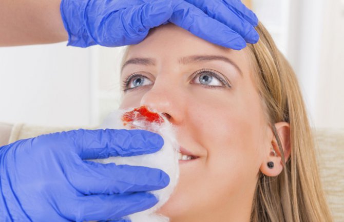 Zašto nikako NE SMIJETE naginjati glavu kad vam curi krv iz nosa