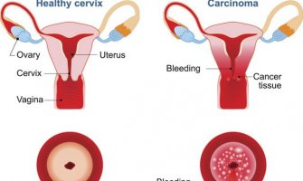 Spriječite infekciju koja je glavni uzrok dobijanja raka kod žena