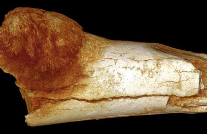 Otkriven RAK na fosilu starom 1,7 miliona godina