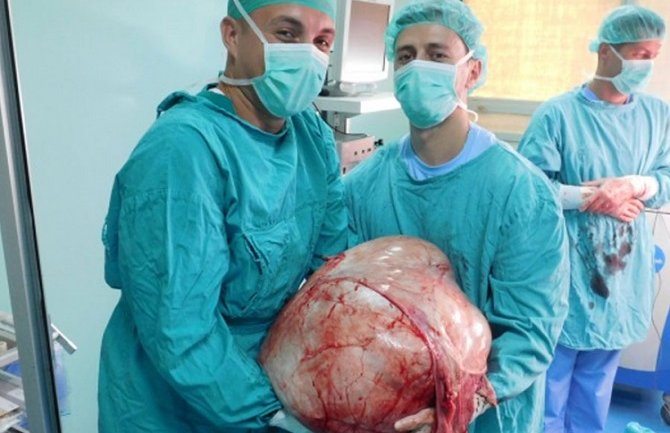Banja Luka: Doktori odstranili tumor težak 31 kilogram