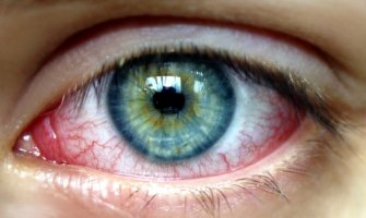 Pucanje kapilara u oku: Kada ovo stanje postaje opasno?