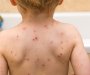 Epidemija varičela u Herceg Novom, preko 300 oboljelih
