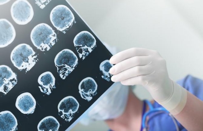 Rezultati skenera: Ženski mozak je tri do četiri godine mlađi od muškog