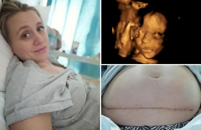 Revolucionarni zahvat: Beba izvađena iz maminog stomaka pa nakon liječenja vraćena nazad
